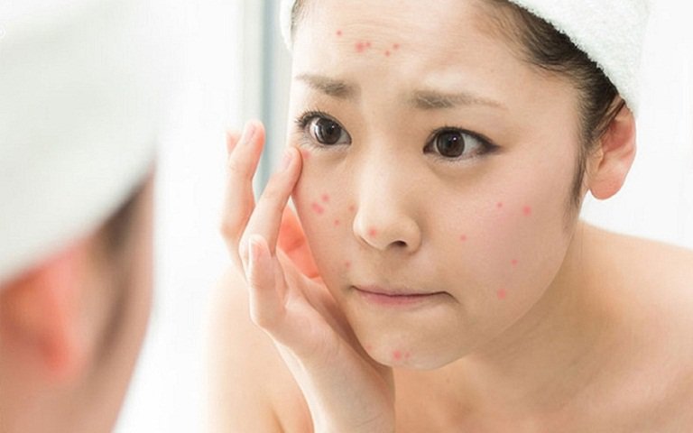 nặn mụn trứng cá